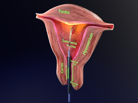 Endometrial Polyp Electrocautery Modello 3D