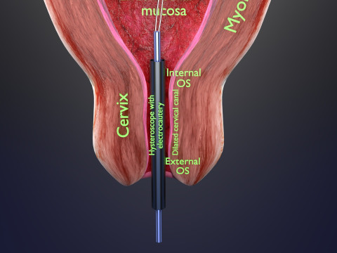Endometrial Polyp Electrocautery Modello 3D