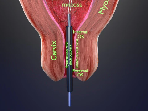 Endometrial Polyp Electrocautery 3D Model