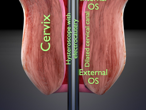 Endometrial Polyp Electrocautery Modello 3D