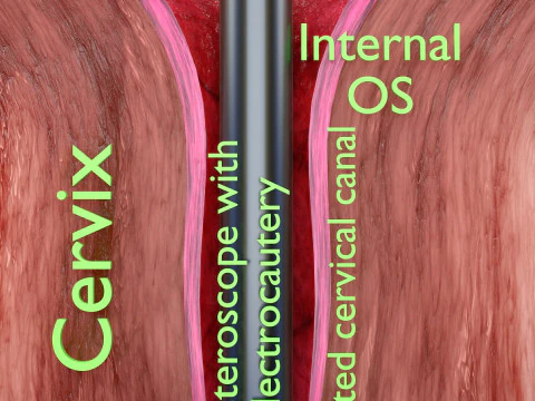 Endometrial Polyp Electrocautery 3D Model