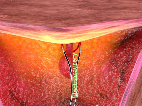 Endometrial Polyp Electrocautery 3D Model