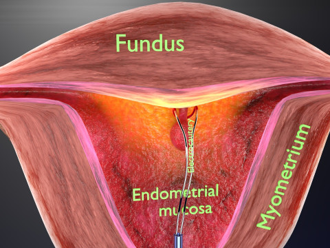 Endometrial Polyp Electrocautery Modello 3D