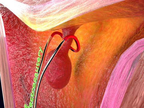 Endometrial Polyp Electrocautery Modello 3D