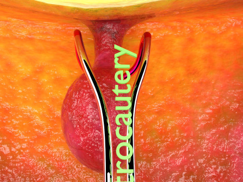 Endometrial Polyp Electrocautery Modello 3D