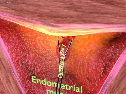 Endometrial Polyp Electrocautery 3D Model