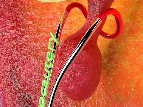 Endometrial Polyp Electrocautery Modello 3D