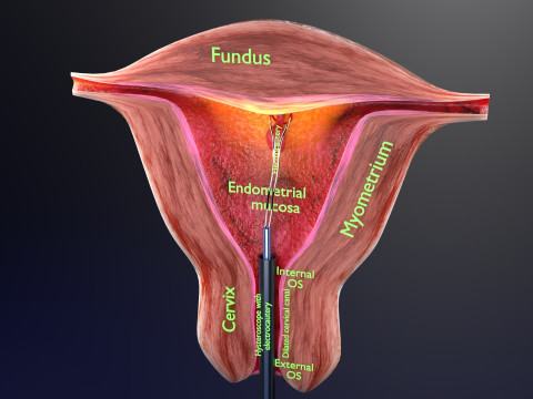 Endometrial Polyp Electrocautery Modello 3D