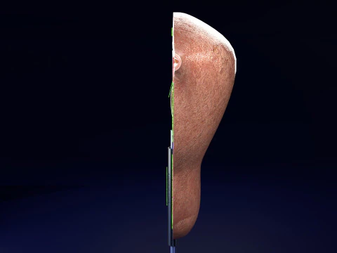 Endometrial Polyp Electrocautery 3D Model