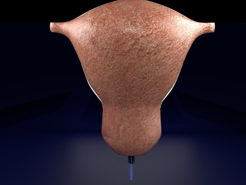 Endometrial Polyp Electrocautery Modello 3D
