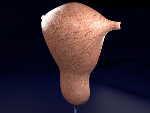 Endometrial Polyp Electrocautery Modello 3D