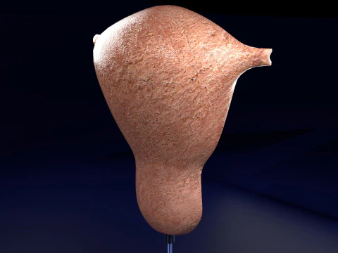 Endometrial Polyp Electrocautery 3D Model