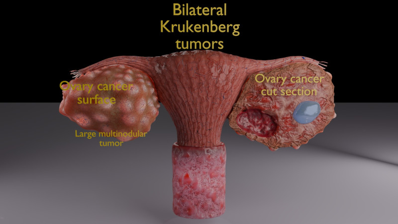 Krukenberg ovarian cancer tumor Modelo 3D .c4d .max .obj .3ds .fbx .stl .blend