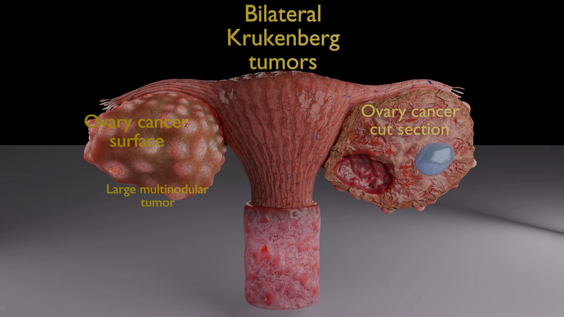 Krukenberg ovarian cancer tumor 3D Model .c4d .max .obj .3ds .fbx .stl .blend 