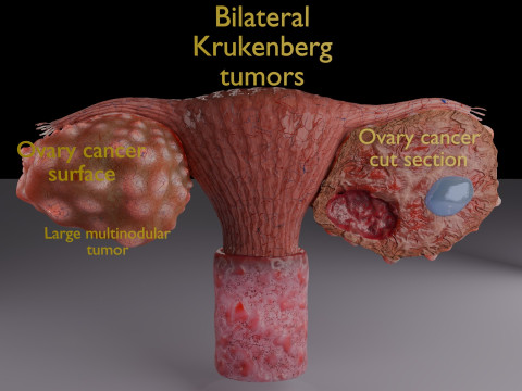 Krukenberg ovarian camcer tumor Modelo 3D