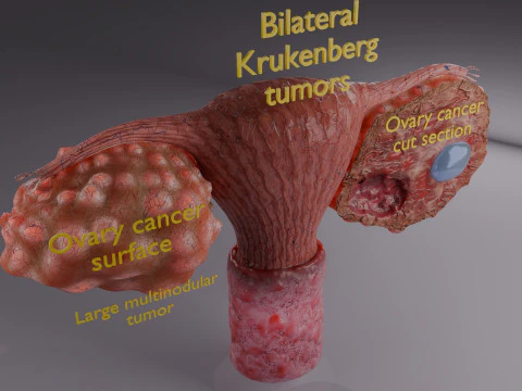 Krukenberg ovarian cancer tumor 3D Model