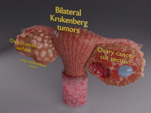 Krukenberg ovarian cancer tumor 3D Model