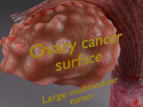 Krukenberg ovarian cancer tumor Modelo 3D