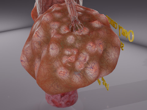 Krukenberg ovarian cancer tumor Modelo 3D