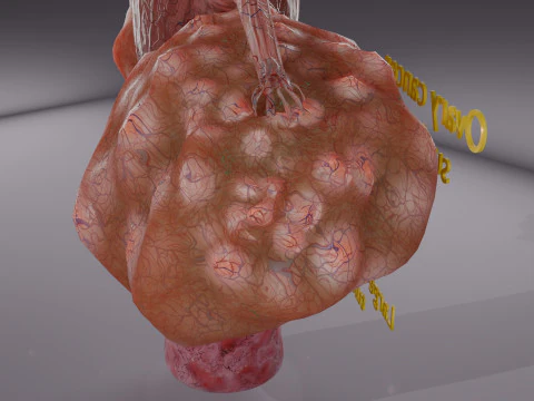 Krukenberg ovarian cancer tumor 3D Model