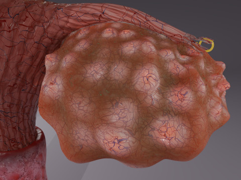 Krukenberg ovarian cancer tumor Modelo 3D