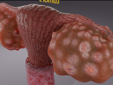 Krukenberg ovarian cancer tumor Modelo 3D