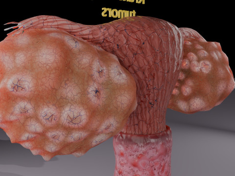 Krukenberg ovarian cancer tumor Modelo 3D