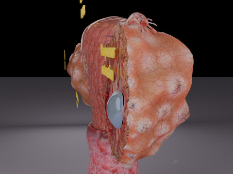Krukenberg ovarian cancer tumor Modelo 3D