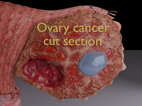 Krukenberg ovarian cancer tumor Modelo 3D