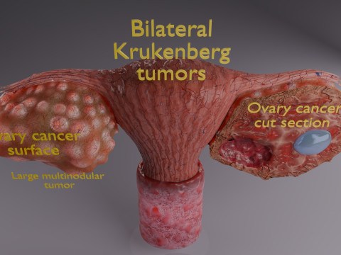 Krukenberg ovarian cancer tumor Modelo 3D