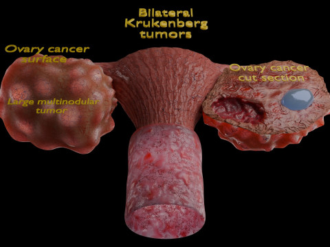 Krukenberg ovarian cancer tumor Modelo 3D