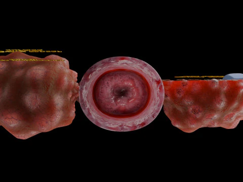 Krukenberg ovarian cancer tumor 3D Model