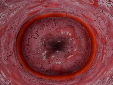 Krukenberg ovarian cancer tumor 3D Model
