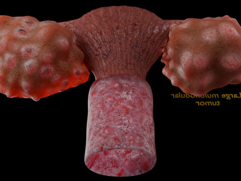 Krukenberg ovarian cancer tumor Modelo 3D
