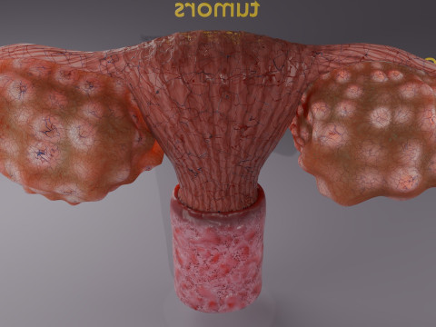 Krukenberg ovarian cancer tumor Modelo 3D