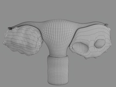 Krukenberg ovarian cancer tumor Modelo 3D