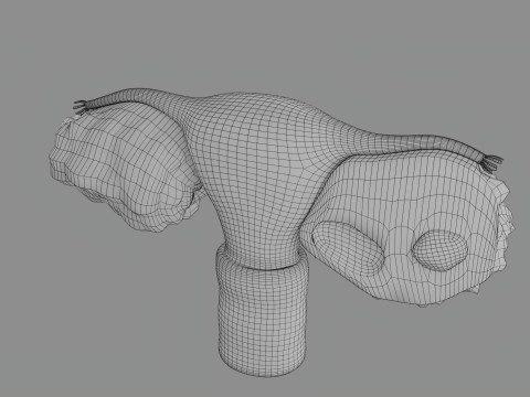 Krukenberg ovarian cancer tumor Modelo 3D