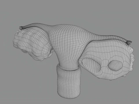 Krukenberg ovarian cancer tumor 3D Model