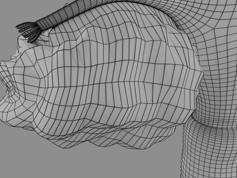 Krukenberg ovarian cancer tumor Modelo 3D