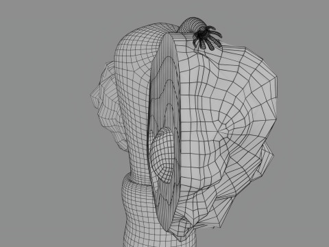 Krukenberg ovarian cancer tumor Modelo 3D