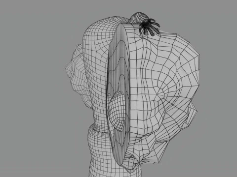 Krukenberg ovarian cancer tumor 3D Model