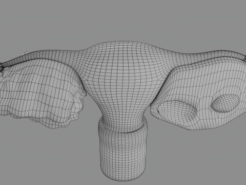Krukenberg ovarian cancer tumor Modelo 3D