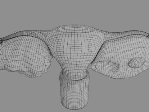 Krukenberg ovarian cancer tumor 3D Model