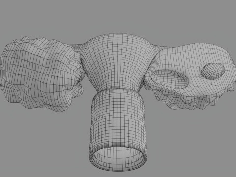 Krukenberg ovarian cancer tumor Modelo 3D