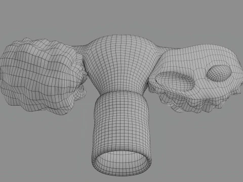 Krukenberg ovarian cancer tumor 3D Model