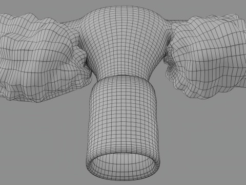 Krukenberg ovarian cancer tumor Modelo 3D