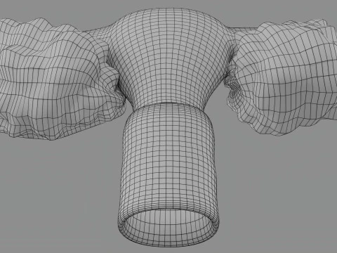 Krukenberg ovarian cancer tumor 3D Model