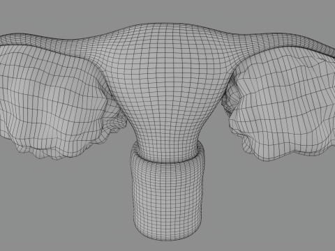Krukenberg ovarian cancer tumor Modelo 3D