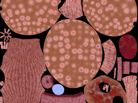 Krukenberg ovarian cancer tumor Modelo 3D