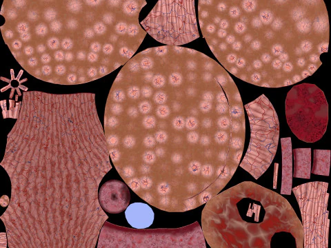 Krukenberg ovarian cancer tumor 3D Model